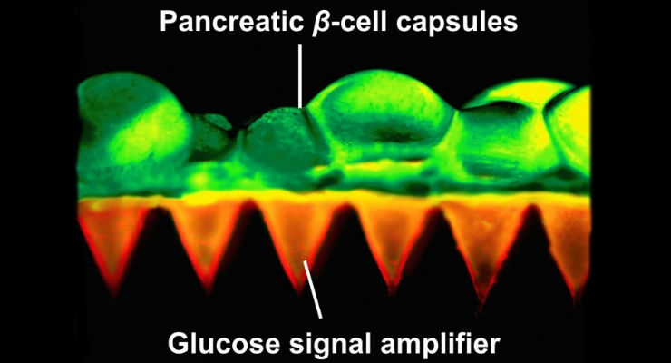 Scientists Create Painless Patch of Insulin-Producing Beta Cells to Control Diabetes 
