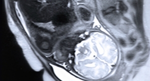 MRI Algorithm Could Help Analyze Fetal Scans to Warrant Interventions