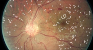 IBM Machine Vision Spots Diabetic Eye Disease Early with Deep Learning
