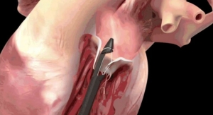 Trial Tests Catheter-Based Approach to Mitral Valve Repair