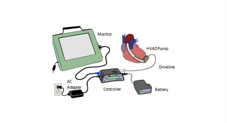 Medtronic Recalls HeartWare HVAD System Over Electrical Issue