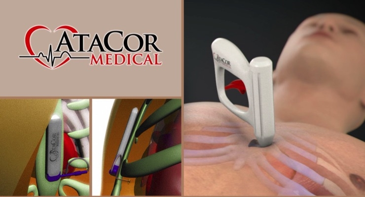  AtaCor Medical Raises $8.8M to Develop Substernal Cardiac Pacing System 
