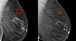 Using AI to Predict Breast Cancer and Personalize Care