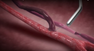 Enrollment Complete in Trial of Arteriovenous Fistula Support Device