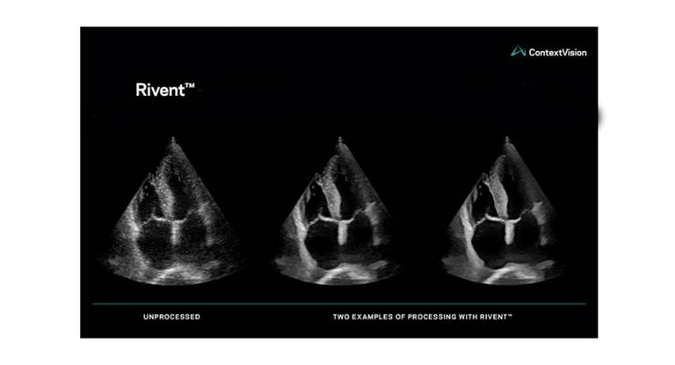ContextVision Redefines Image Enhancement for Ultrasound