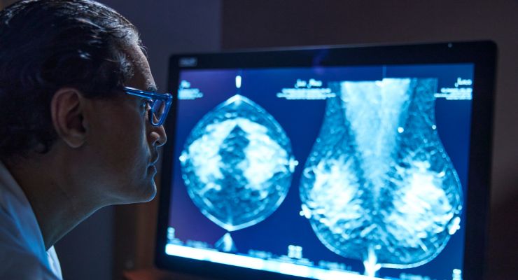 Study Finds Tomosynthesis Better at Breast Cancer Detection than Standard Mammography