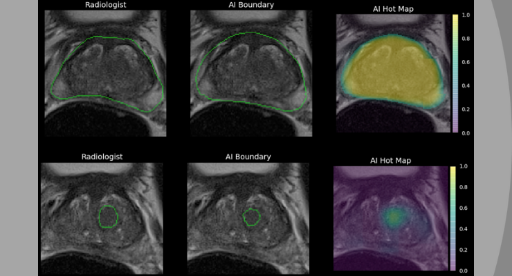 FDA Clears AI Tech That Enhances MRI Screening
