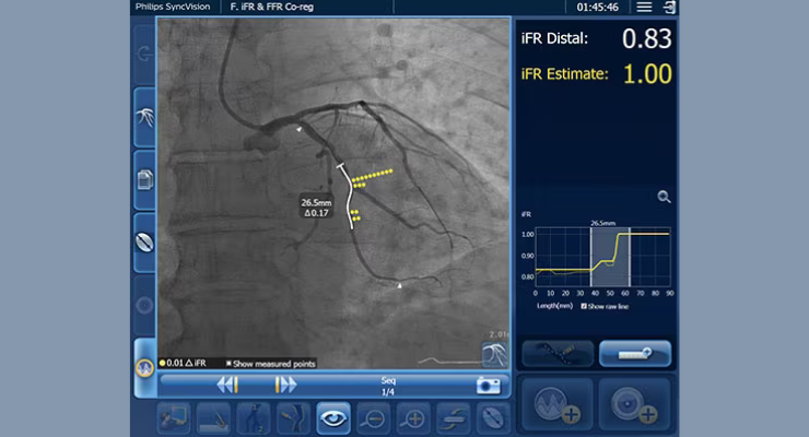 Analysis Shows iFR and FFR are Equally Safe to Diagnose and Treat Heart Disease