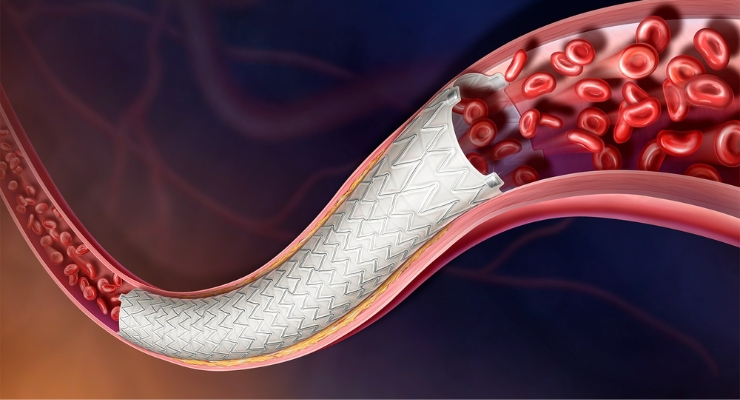 BD Begins AGILITY IDE Trial for Vascular Covered Stent