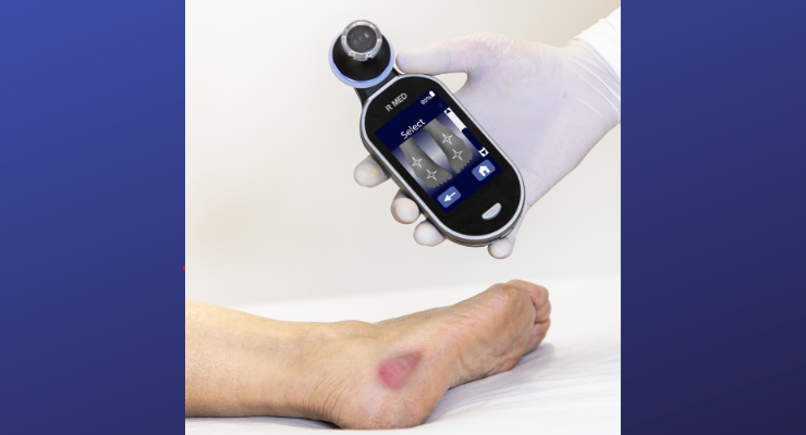 clinical-data-support-early-detection-ability-of-ir-meds-pressure-injury-device