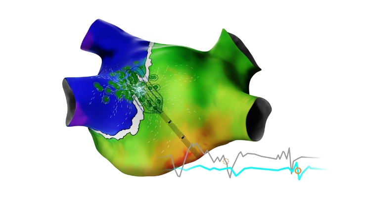jjs-biosense-webster-rolls-out-ai-enhanced-version-of-heart-mapping-tech