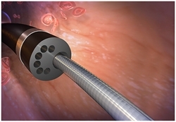 TRI’s ND Infusion Catheter Used to Deliver Stem Cells Into Heart 