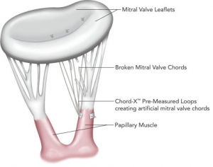 On-X Life Technologies Launces Mitral Valve Chordal Repair System