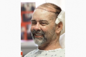 Texas Surgeons Perform Historic Skull and Scalp Transplant 