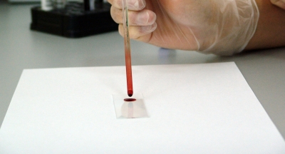 Detecting Cancer from a Single Drop of Blood