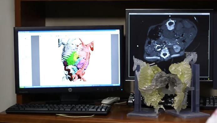 CT and 3-D Printing Aid Surgical Separation of Conjoined Twins 