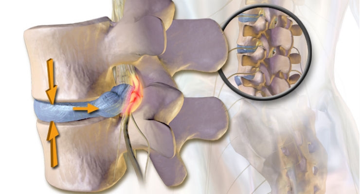 Innovative Tissue Engineering Strategies to Repair Spinal Disc Herniation 