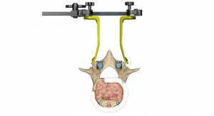 Stryker Introduces Xia 4.5 Cortical Trajectory Implants at AAOS Meeting
