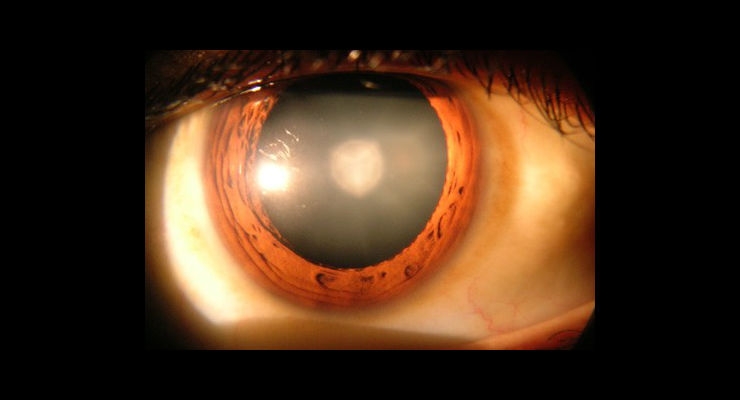 Stem Cells Regenerate Human Lens After Cataract Surgery, Restoring Vision 
