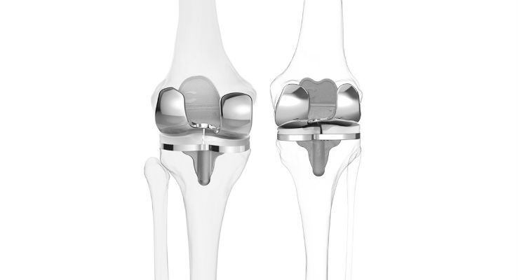 Custom Knee Implants Offer More Natural Movement