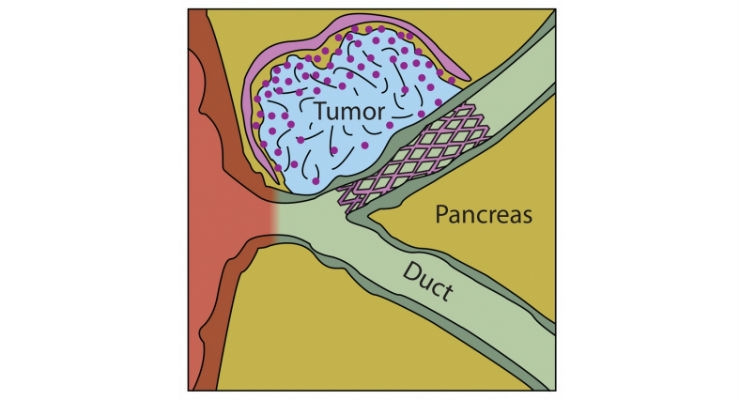 Implantable Device Targets Pancreatic Cancer
