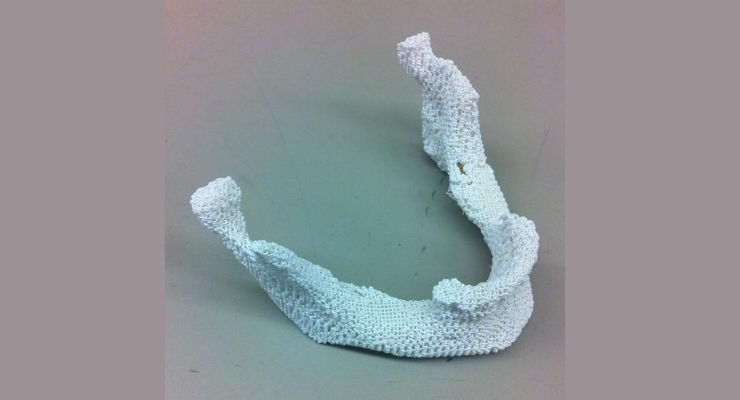 3D Printing Offers a Better Bone Replacement