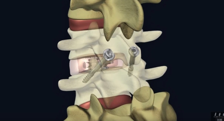 FDA Clears Interventional Spine