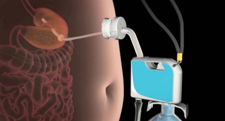 FDA Approves AspireAssist Obesity Device