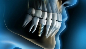 Getting to the Root of Dental Implants