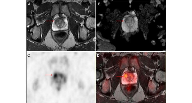 PET/MRI: A One-Stop Imaging Test to Detect Prostate Cancer?
