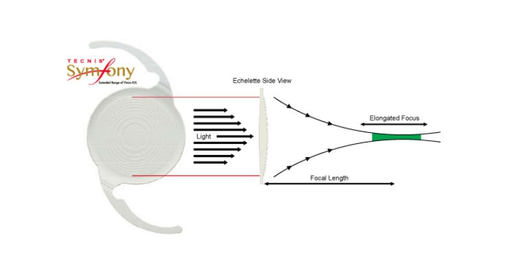 FDA Approves First Intraocular Lens with Extended Range of Vision for Cataract Patients