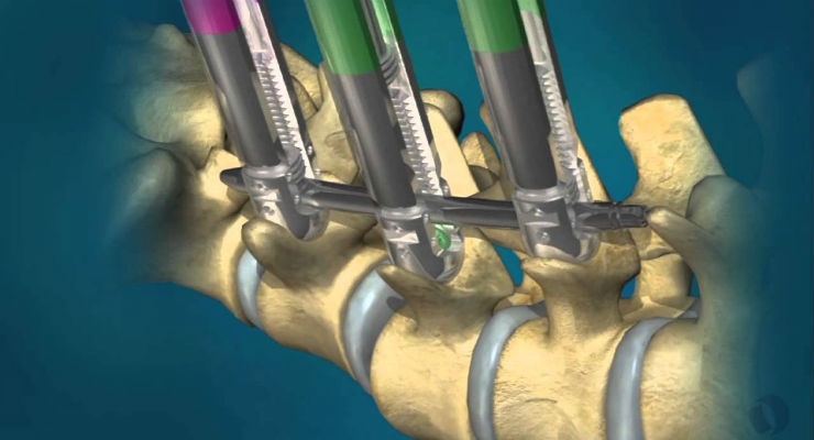 Orthofix Gains Japanese Approval and Launches Minimally Invasive Spinal Fixation System