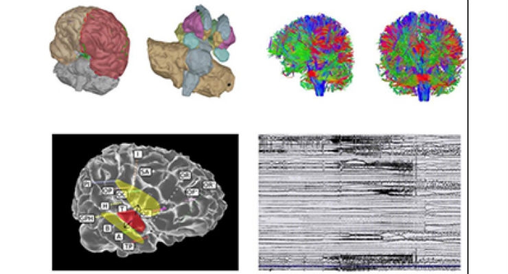 A Virtual Brain Helps Decrypt Epilepsy