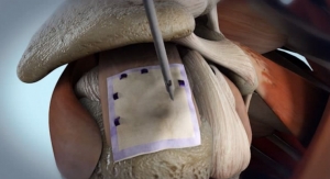 Bioinductive Implant Induces New Tissue in Partial-Thickness Rotator Cuff Tear Patients