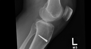 X-rays: First & Best Screening Tool for Knee Pain Diagnosis Among Middle-Aged Patients