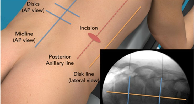 Minimally Invasive Direct Thoracic Interbody Fusion Proves Effective for Back Pain