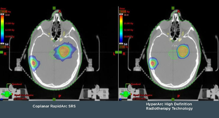 Varian Exhibiting New HyperArc Technology for High Definition Radiotherapy and Radiosurgery