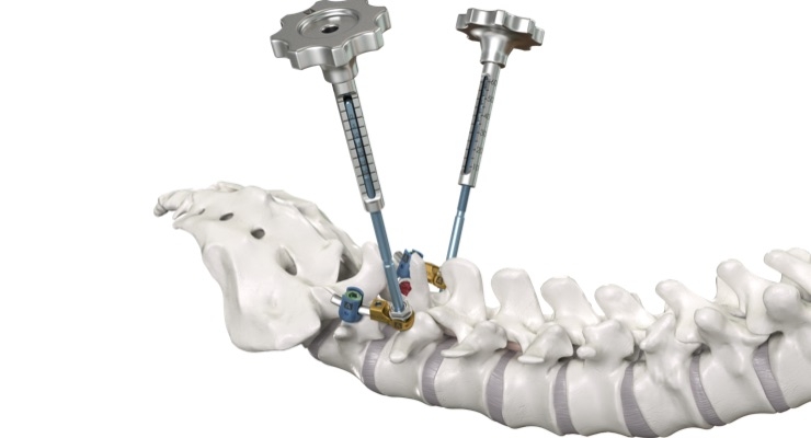  Amendia Launches New SYZYGY Spine Stabilization System 
