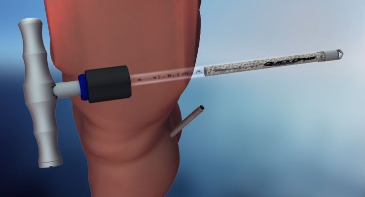 NASS News: Paradigm BioDevices Completes 25,000th QuickDraw MIS Bone Harvester Procedure
