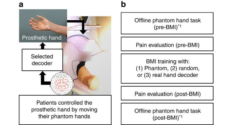 Cause of Phantom Limb Pain and Potential Treatment for Amputees Identified