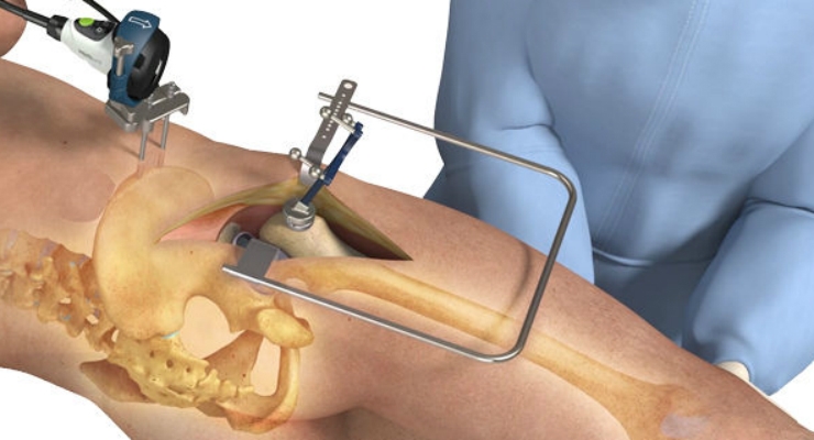 Intellijoint Surgical Raises $11MM to Expand U.S. Launch of intellijoint HIP