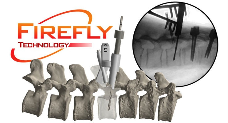 Second FDA Clearance for Patient-Specific 3D-Printed Firefly Pedicle Screw Navigation Guides
