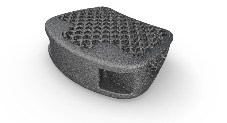 3D-Printed Spinal Cage Manufacturer Receives Growth Financing 