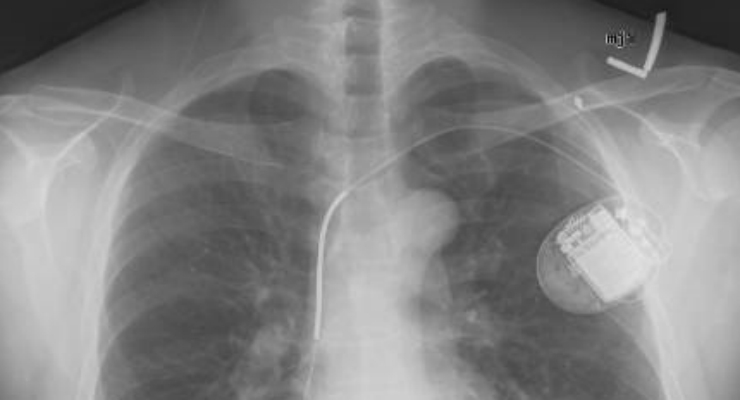 High Survival Rate for Elderly Patients with Implantable Defibrillator