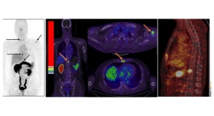 New PET Imaging Spots Primary and Metastatic Prostate Cancer