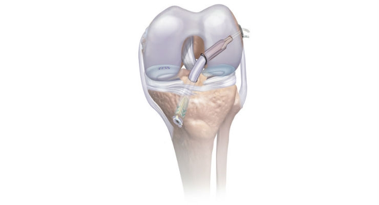 AAOS: DePuy Synthes Reveals Knee Arthroscopy Platform for ACL and Meniscal Repair
