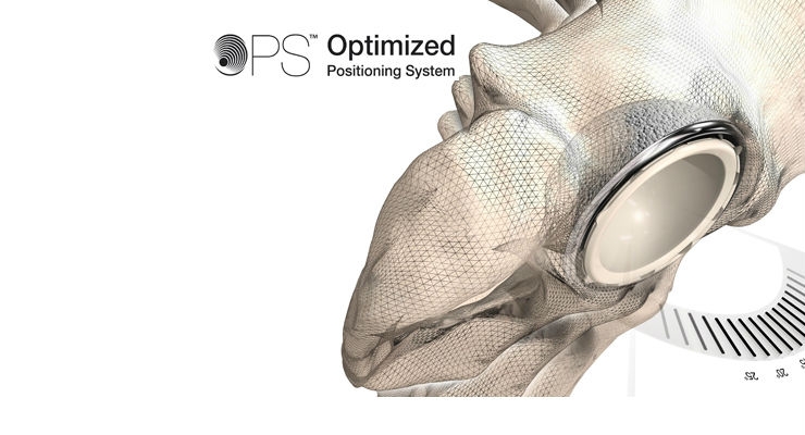 AAOS: Optimized Positioning System for Hip Replacement Launched