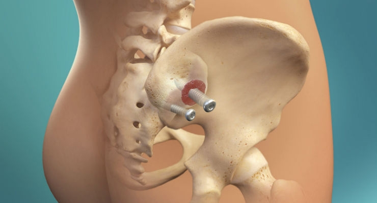 2-Year CT Fusion and Clinical Results for SImmetry SI Joint Fusion with Decortication