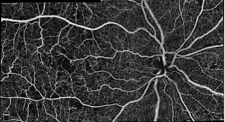 Optovue First to Release High Density OCT Angiography for Ophthalmology 