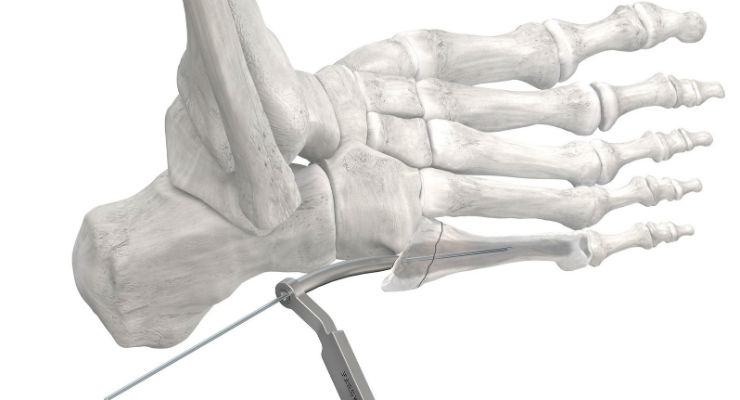 Paragon 28 Launches Screw and Instrumentation System for Jones Fractures